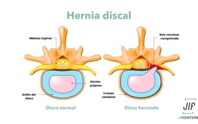 5 Claves para Entender y Superar la Hernia Discal mediante la fisioterapia