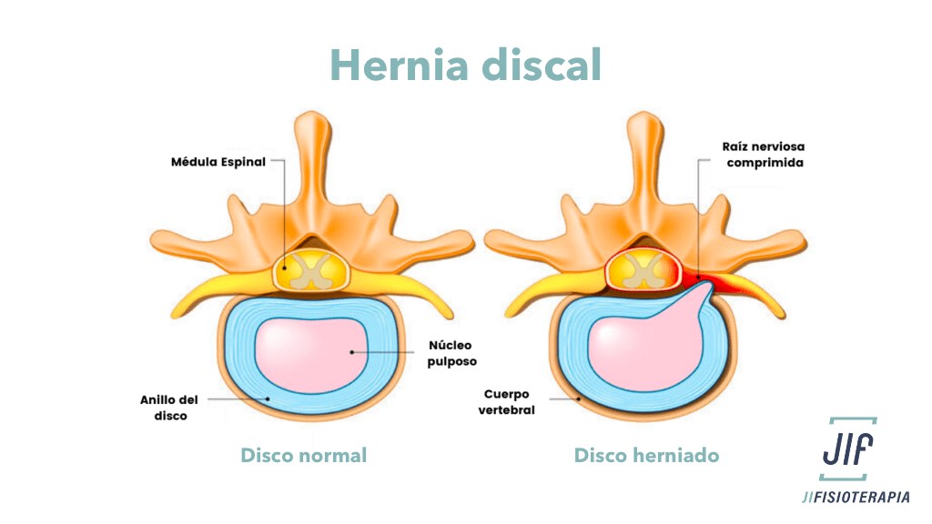 5 Claves para Entender y Superar la Hernia Discal mediante la fisioterapia